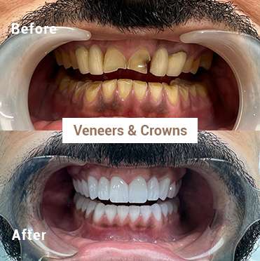 Veneers-Crowns-Before-After