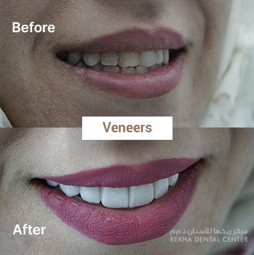 before-after-Veneers-1