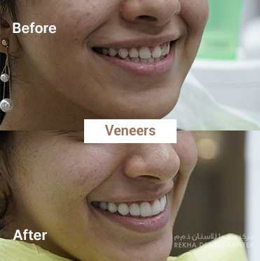before-after-Veneers-2